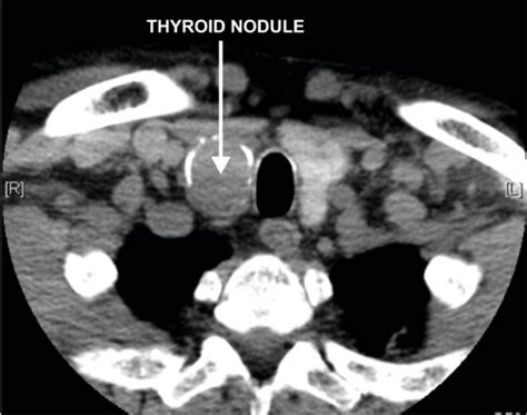 Ct Scan Demonstrating 43 × 25 Cm Partially Calcified Complex Dominant