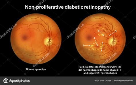 Nonproliferative Diabetic Retinopathy Vs Proliferative