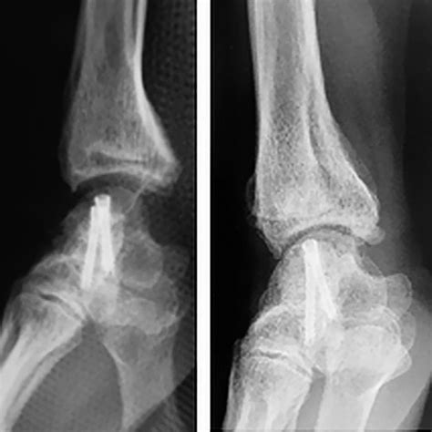 Immediate Postoperative Antero Posterior And Lateral Left Wrist X Ray