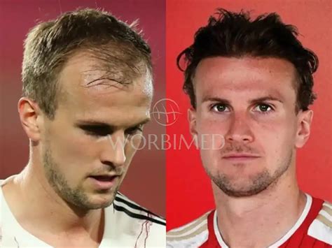 Rob Holding Hair Transplant Before And After