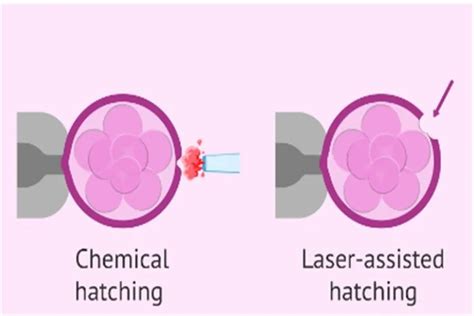 Assisted Hatching In Ivf Procedure Indications And Benefits