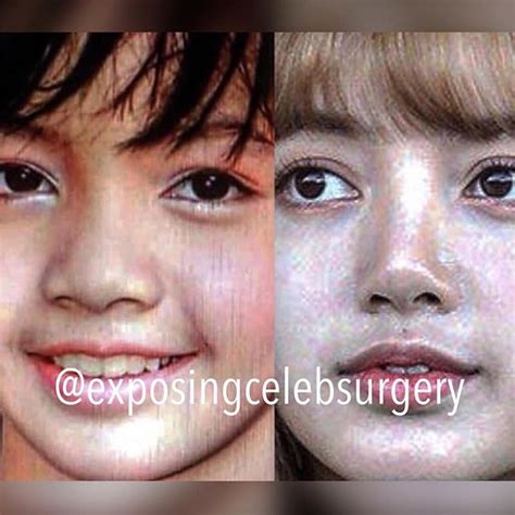 Surgeryphotoshopdrama Exposingcelebsurgery • Instagram Photos And