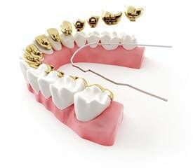 Lingual Braces Pros and Cons and Additional Braces Options