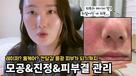 내돈내산 찐템들👛 지성여드름 피부의 모공관리 홈케어 · 피부과 모공시술 · 재생크림추천 Youtube