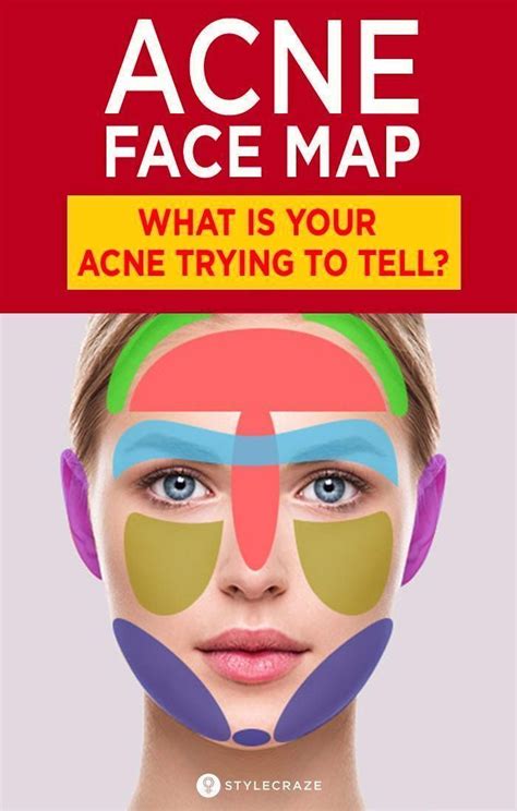 Acne Face Map What Is Your Acne Trying To Tell You In 2021 Face Mapping Acne Face Acne