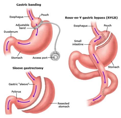 Weight Loss Surgery Types Costs Indications Side Effects And Benefits