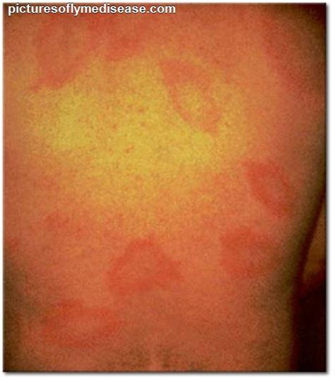 Lyme Disease Rash Photos Pictures Photos