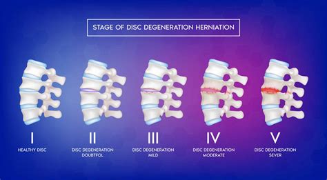 Stages Of Degenerative Disc Disease