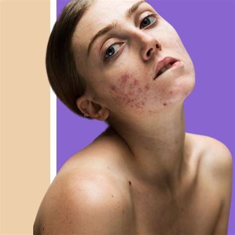 Come Cancellare Le Cicatrici Da Acne Per Sempre Thepowderoom