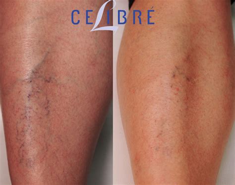 Varicose Veins Treatment Before And After