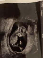 Any Guesses Boy Or Girl 12 Week Scan Mumsnet