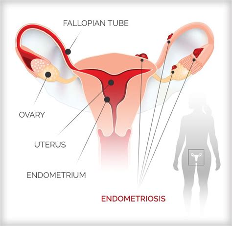 How Do I Know If I Have Endometriosis Telegraph