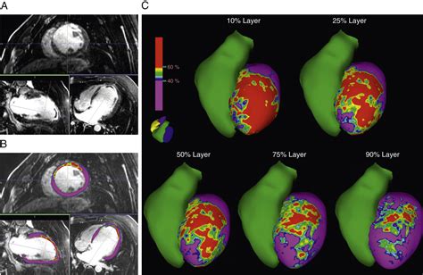 Scar Characterization To Predict Life Threatening Arrhythmic Events And