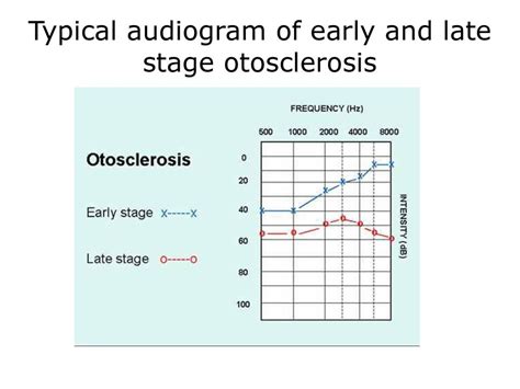 Otosclerosis Audiogram