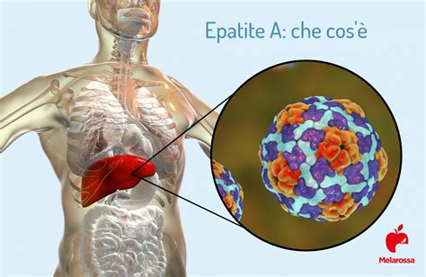 Epatite A che cosè sintomi cause cura e come si trasmette