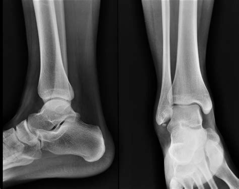 Os subfibulare | Radiology Case | Radiopaedia.org | Radiology ...