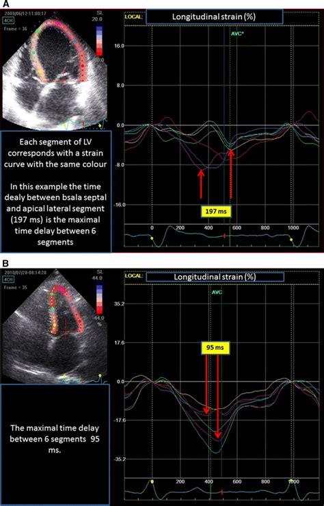 An Example Of Speckle Tracking Longitudinal Strain Analysis