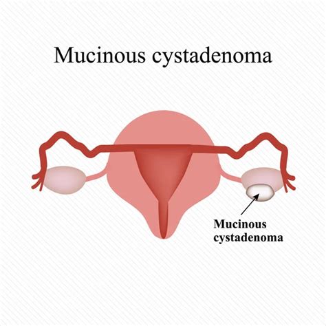 Dermoid Cyst On The Ovary Ovary Infographics Vector Illustration — Stock Vector © Mikrostoker