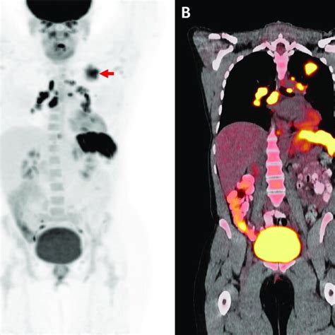 Impact Of F Fdg Pet Ct On Diagnostic Management Mip Pet A And