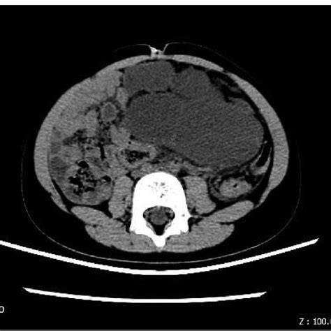 Intraoperative Findings Of Intra Abdominal Lymphatic Malformation A Download Scientific