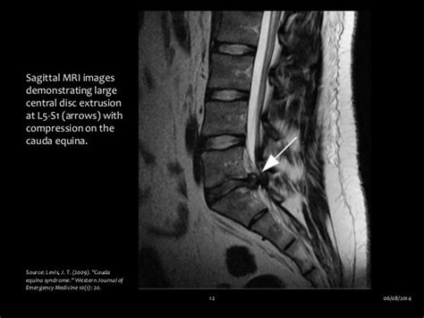 Conus medullaris and cauda equina syndrome