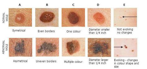 Abcdef S Of Changing Moles Melanoma