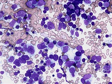 Is Diffuse Large B Cell Lymphoma Non Hodgkins