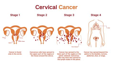 Treatment Of Cervical Cancer