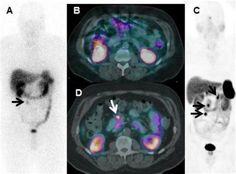 Ga Dotatate Pet Ct V In Image Eurekalert Science News Releases