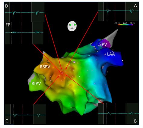 A Focal Atrial Tachycardia Located In Front Of The Right Superior