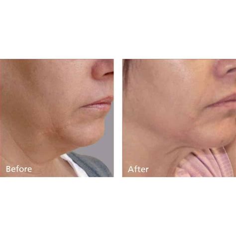 Forma Rf Skin Tightening In Alpharetta Ga