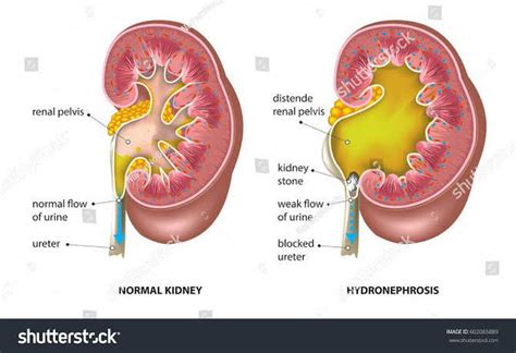 Hydronephrosis treatment - MEDizzy