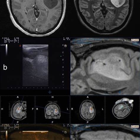 A Contrast Enhanced T And Flair Weighted Axial Mri Scans Showing A