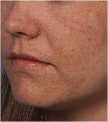 Fraxel Skin Resurfacing Treatment