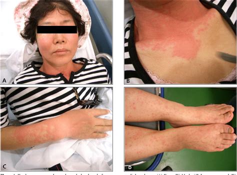 Figure 1 From A Case Of Photosensitivity Reaction After Photodynamic Therapy For Biliary