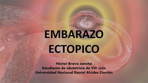 Embarazo Ectópico OBS NOTES uDocz