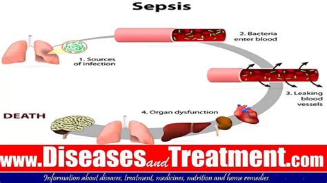 Sepsis Blood Poisoning Septicemia Causes Symptoms Diagnosis | The Best Porn Website