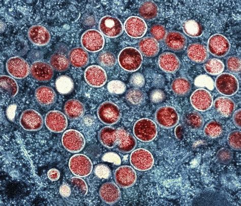 First Case Of New Mpox Variant Detected In Germany