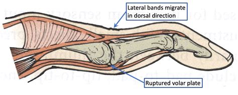 Swan Neck Deformity