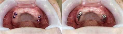 Bar-retained implant overdenture for treating edentulous maxilla | TRATE