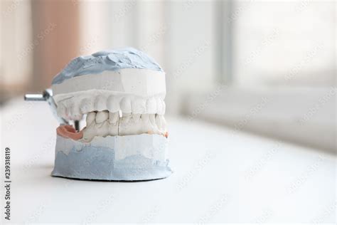 Plaster Cast Of Jaws Dental Casting Gypsum Model Human Jaws In