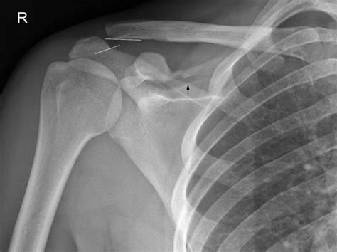 Acromioclavicular Ac Joint Injuries Core Em