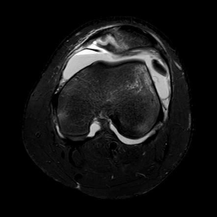 Transient Lateral Patellar Dislocation With Osteochondral Injury