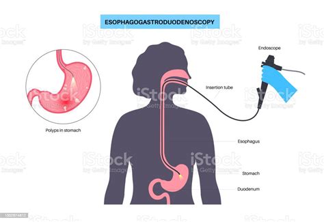 Gastroscopy Endoscopy Procedure Stock Illustration - Download Image Now ...