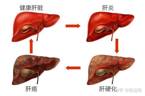 肝硬化腹水怎么治疗重要知识点整理让你一文掌握 知乎