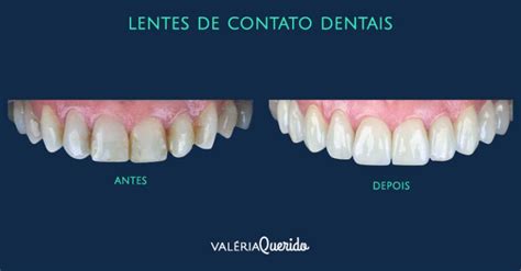 Entenda as diferenças entre Facetas e Lentes de Contato Dentais