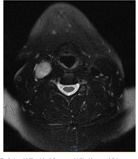 Figure From Cervical Sympathetic Chain Schwannoma Masquerading As A