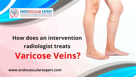 How Does An Interventional Radiologist Treat Varicose Veins