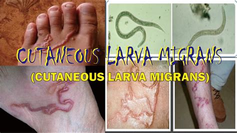 CUTANEOUS LARVA MIGRANS Definisi Penyebab Gejala Pengobatan