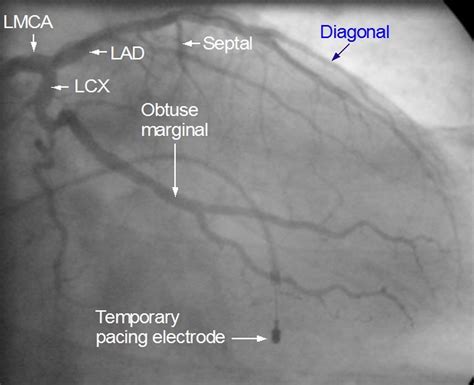 Coronary Angiogram – All About Cardiovascular System and Disorders